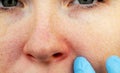 Cuperosis on the nose of a young woman. Acne on the face. Examination by a doctor