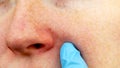 Cuperosis on the nose of a young woman. Acne on the face. Examination by a doctor