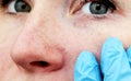 Cuperosis on the nose of a young woman. Acne on the face. Examination by a doctor