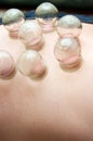 Cupping therapy