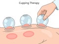 Cupping Therapy Procedure diagram medical science