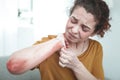 Curly woman feeling painful having rash and reddening on arm Royalty Free Stock Photo