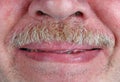 Curved smile of a toothless old man with sore skin and gray must