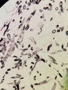 Curvularia fungal hyphae with GMS stain