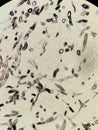 Curvularia fungal hyphae with GMS stain