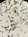 Curvularia fungal hyphae with GMS stain