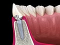 Custom abutment, dental implant and ceramic crown. Medically accurate tooth 3D illustration