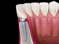 Custom abutment, dental implant and ceramic crown. Medically accurate tooth 3D illustration