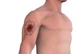 Cutaneous leishmaniasis, morphology of ulcer Royalty Free Stock Photo