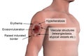 Cutaneous leishmaniasis, skin ulcer