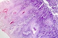 Cutaneous squamous cell carcinoma Royalty Free Stock Photo