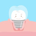 Cute cartoon dental implants