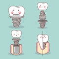 Cute cartoon tooth implant