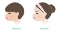 Cute women with whiteheads and blackheads acne on noses vector illustration.