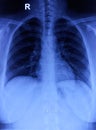 CXR (Chest X-Ray) PA view. Cervical ribs, normal findings Royalty Free Stock Photo
