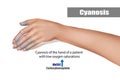 Cyanosis of the hand of a patient with low oxygen saturations