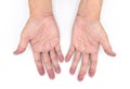 Cyanotic hands or central cyanosis or blue hands at Asian young man with congenital heart disease