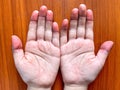 Cyanotic hands or peripheral cyanosis or blue hands at Asian child with congenital heart disease