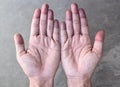 Cyanotic hands or peripheral cyanosis or blue hands at Asian man
