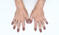 Cyanotic hands or peripheral cyanosis or blue hands at Asian man with congenital heart disease