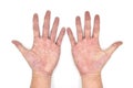 Cyanotic hands or peripheral cyanosis or blue hands at Southeast Asian, Chinese male patient