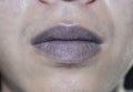 Cyanotic lips or central cyanosis at Southeast Asian, Chinese young man with congenital heart disease.