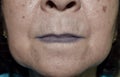 Cyanotic lips or central cyanosis at Southeast Asian old woman
