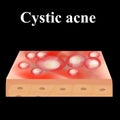 Cyst acne. Acne on the skin of a cyst. Dermatological and cosmetic diseases on the skin of the face. Infographics