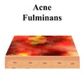 Cyst acne. furuncle Acne on the skin cysts and pimples. Dermatological and cosmetic inflammatory diseases on the skin of