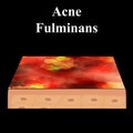 Cyst acne. furuncle Acne on the skin cysts and pimples. Dermatological and cosmetic inflammatory diseases on the skin of