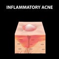 Cyst acne. furuncle Acne on the skin cysts and pimples. Dermatological and cosmetic inflammatory diseases on the skin of