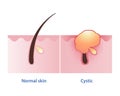 Cystic acne, the most severe type of inflammatory acne vector on white background.