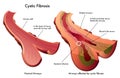 Cystic fibrosis