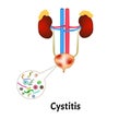 Cystitis. Inflammation of the bladder. The structure of the kidneys and bladder. Excretory system. Infographics. Vector