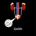 Cystitis. Inflammation of the bladder. The structure of the kidneys and bladder. Excretory system. Infographics. Vector Royalty Free Stock Photo