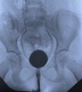 Cystography urological xray image bladder