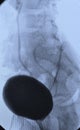 Cystography urological xray image bladder