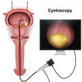 Cystoscopy of the bladder 3d illustration on white background