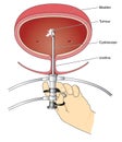 Cystoscopy of bladder Royalty Free Stock Photo