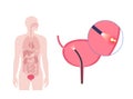 Cystoscopy examination concept