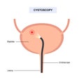 Cystoscopy examination concept