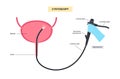 Cystoscopy examination concept