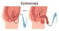 Cystoscopy set. Male and female bladder surface examination with a flexible Royalty Free Stock Photo