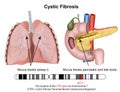 Cystric fibrosis 3d medical illustration with description