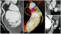 3D angio tomography heart lcx artery collage