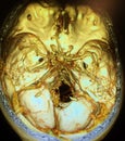 3D angio tomography scan brain vessels