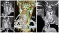 3D angio tomography scan left vertebral artery collage