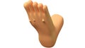 3D Cartoon Foot Warts Plantar warts