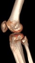3D CT Volume Rendering Knee