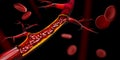 3d illustration of Blocked blood vessel - artery with cholesterol buildup realistic Royalty Free Stock Photo